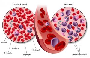 Risks, causes, and symptoms of Acute Myeloid Leukemia (AML) – Weekly Citizen