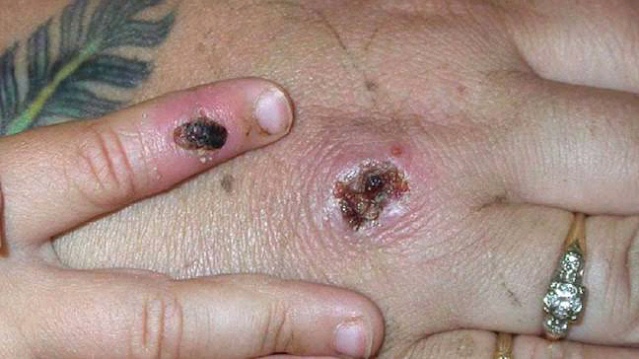 monkeypox pictures, monkeypox virus 2022  pictures
