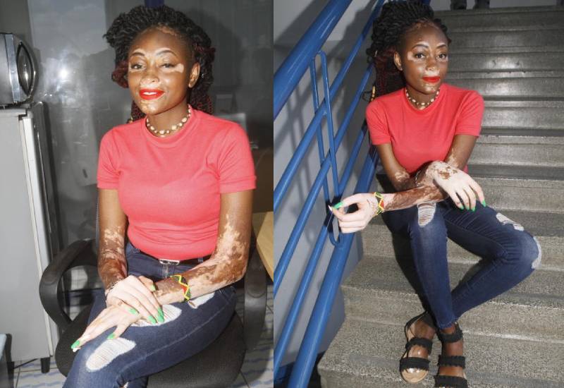 Patchy and pretty: My scars, my pride