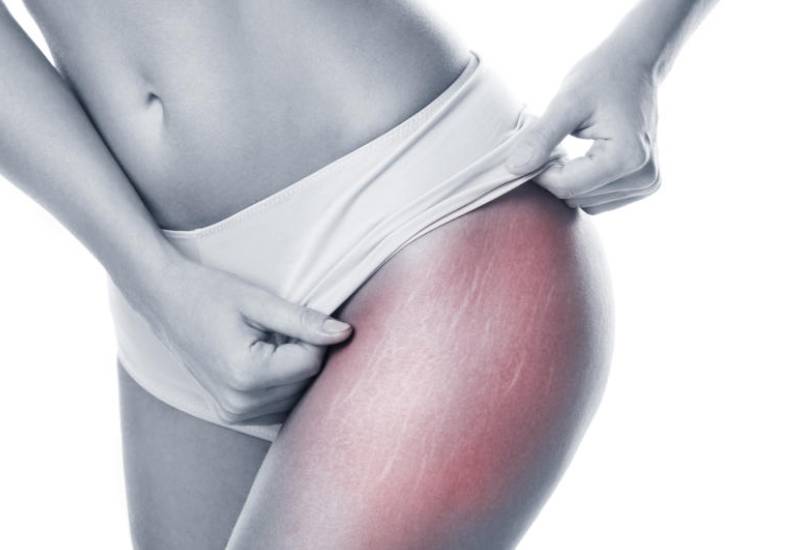 Natural remedies to fade stretch marks Eve woman
