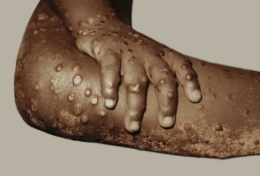 CDC Monitoring Potential Outbreak Of Another Virus;