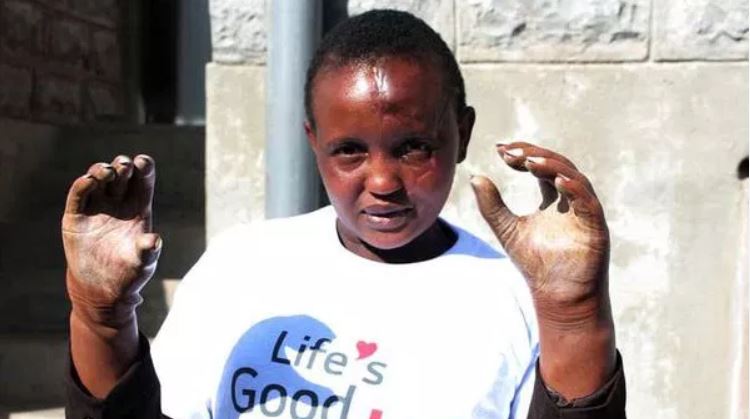 Jackline Mwende Ditches “Expensive To Maintain” Prosthetic Limbs