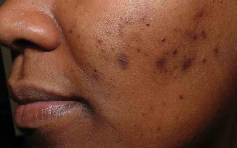 How to get rid of acne scars with these home remedies