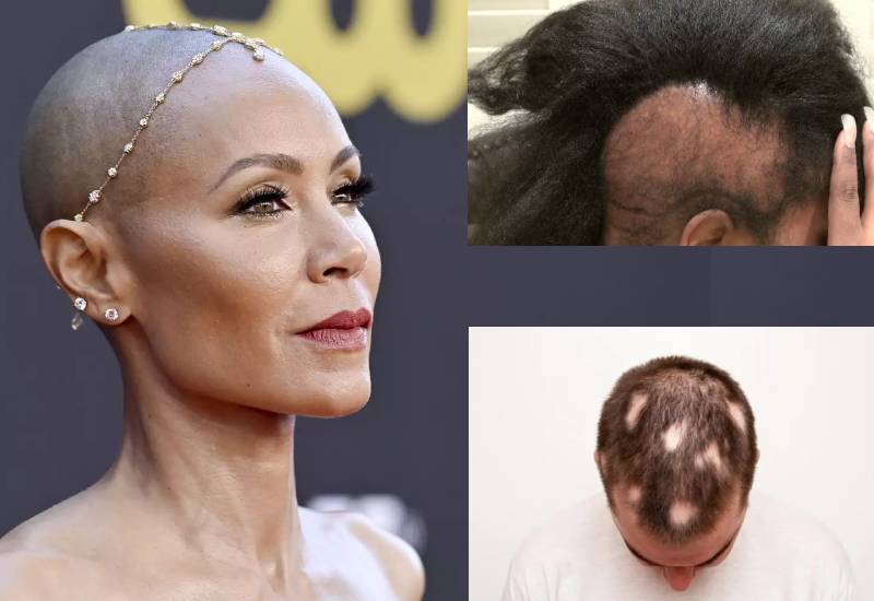 The condition at centre of Oscars’ slap Eve woman