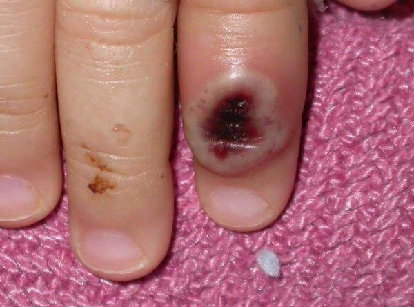 monkeypox pictures, monkeypox virus 2022  pictures