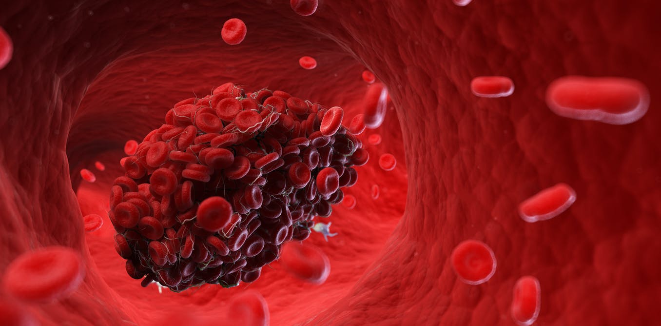 8 Factors That Increase Risk of Developing Blood Clots