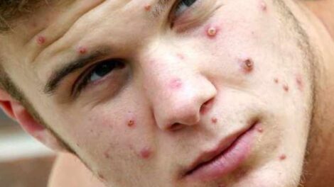 Gays report most cases of monkeypox as WHO spearheads fight against stigma – Nairobi News