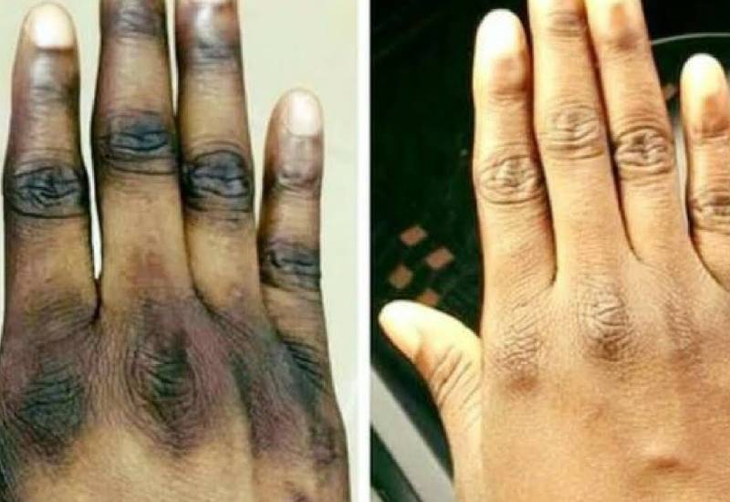 How to lighten dark knuckles naturally Eve woman