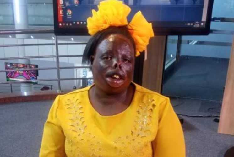 I Watched My Husband Get Killed, Had My Face Burned and Left in Morgue