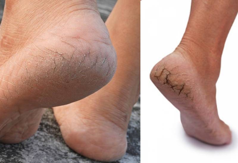 How to soften cracked heels Eve woman