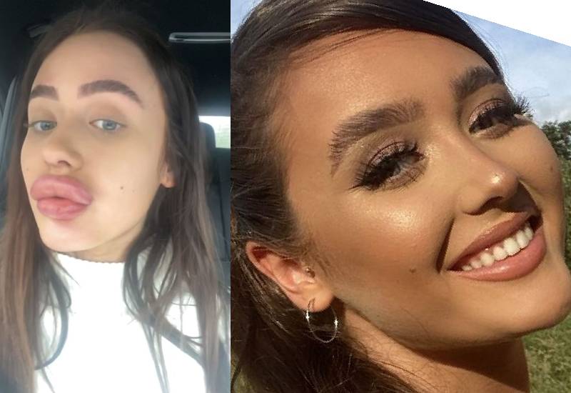 Woman forced to hide at home after lip filler fail left her with 'baboon's bum' pout