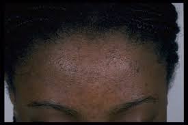 Tips of getting rid of Acne fast – Weekly Citizen