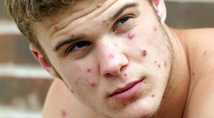 No Monkeypox in Kenya But Govt on High Alert, Health PS Says