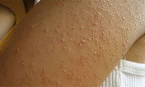Some people are allergic to cold weather – Weekly Citizen