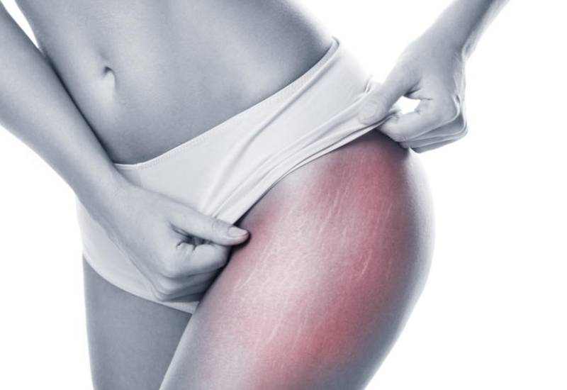 Natural ways you can fade stretch marks Eve woman