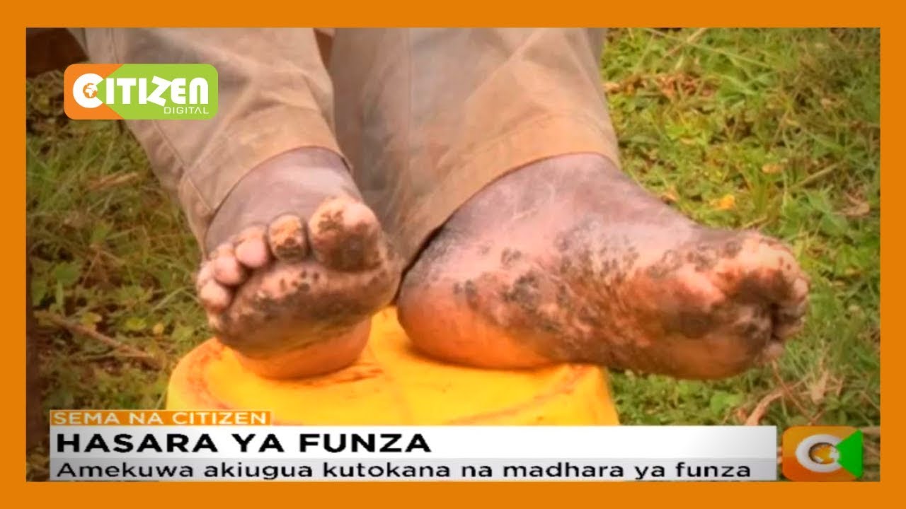 Mzee aishi na funza kwa muda wa miaka 15 Kisii