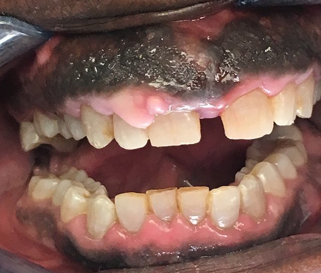 Why Some People Have Black Gums