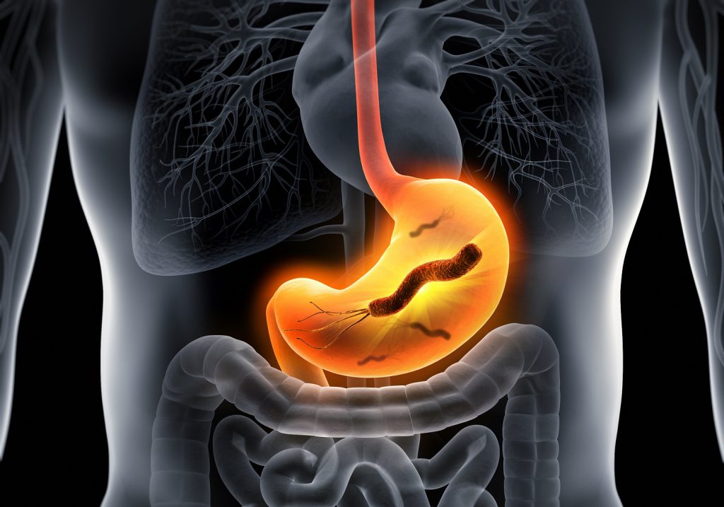 Causes, Signs and Symptoms of H. pylori Bacteria Infection