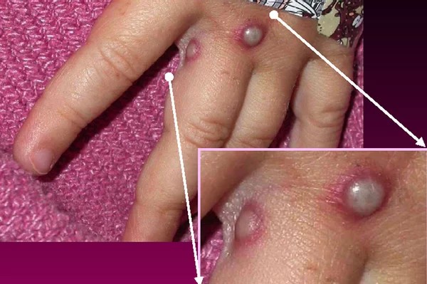 Monkeypox virus symptoms, treatment, vaccine and death rate