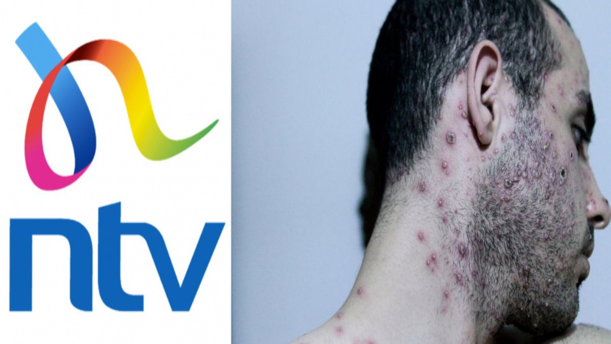 NTV Earns Gangster Points After Using Wazungu's Photos to Report Monkeypox